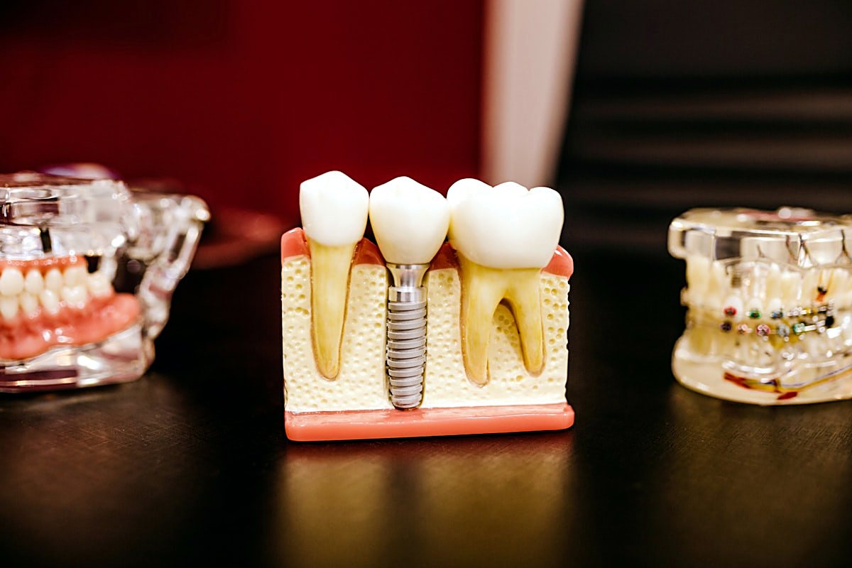 A model showing how a dental implant sits in the jaw
